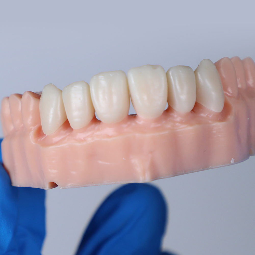 Ceramic Crown Resin application 2
