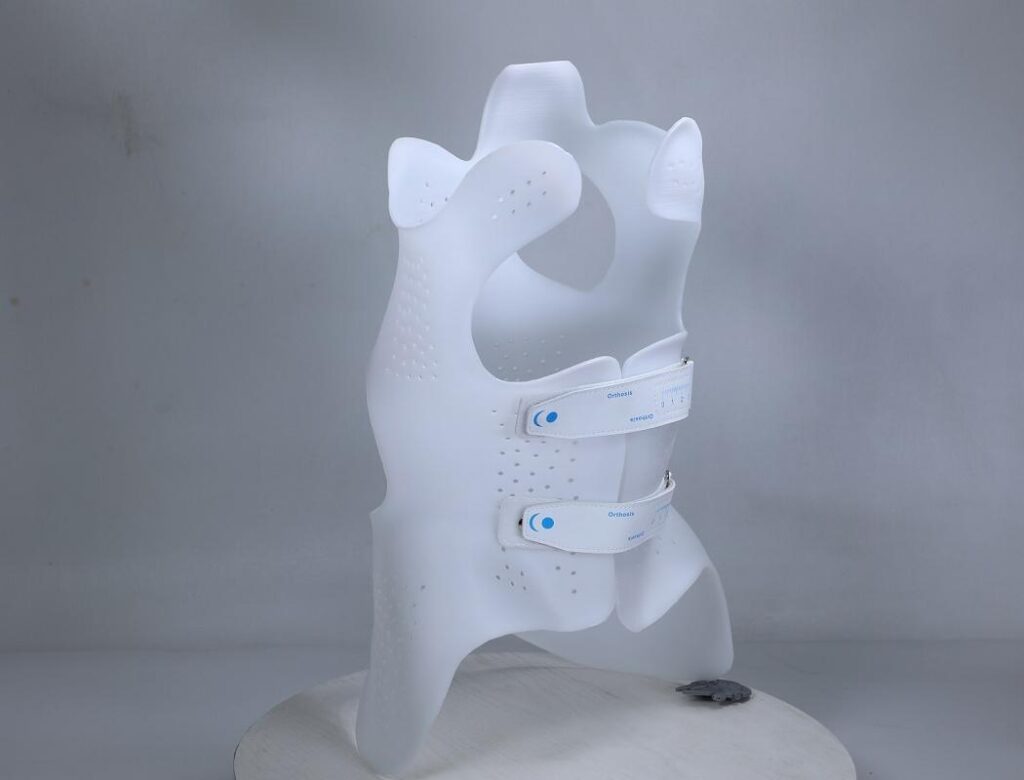 3D Printed Scoliosis Braces: Transforming Orthotic Care with Precision and Comfort