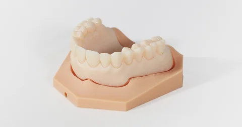 Printed dental arch model with a removable tooth-colored restoration